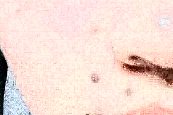 2024沈陽盛京醫(yī)院去痣好不好?體驗(yàn)日記反饋