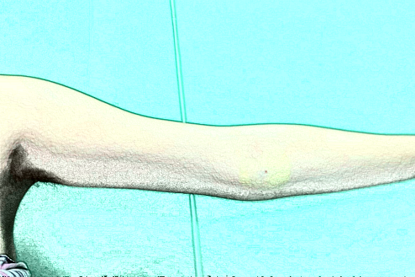 南京鼓樓醫(yī)院吸脂怎么樣_體驗日記分享