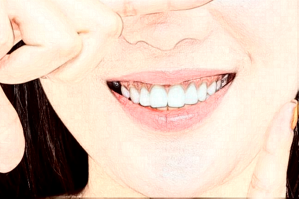 長(zhǎng)沙科爾雅口腔醫(yī)院瓷貼面好的醫(yī)生推薦_美容日記展示