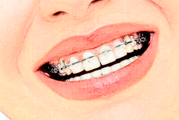 2024山西省人民醫(yī)院成人正畸價目表(價格表)_口碑怎么樣