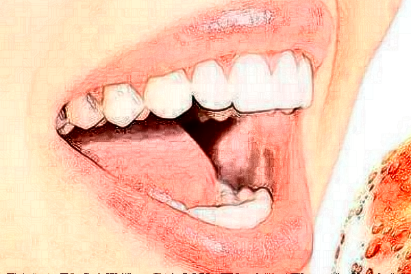 2024天津醫(yī)科大學(xué)總醫(yī)院口腔科冷光美白做的好嗎?整形日記分享