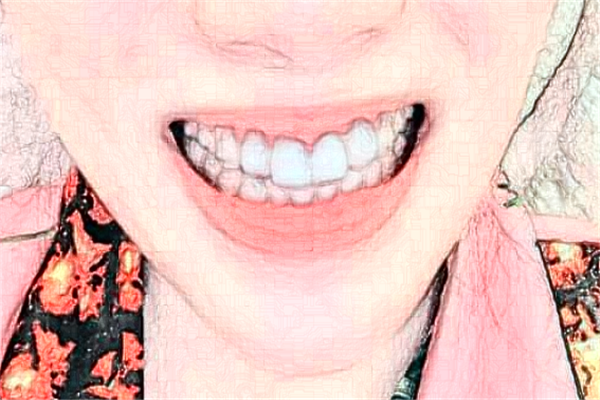 2024河北大學(xué)附屬醫(yī)院牙齒矯正多少錢_牙齒矯正醫(yī)生推薦