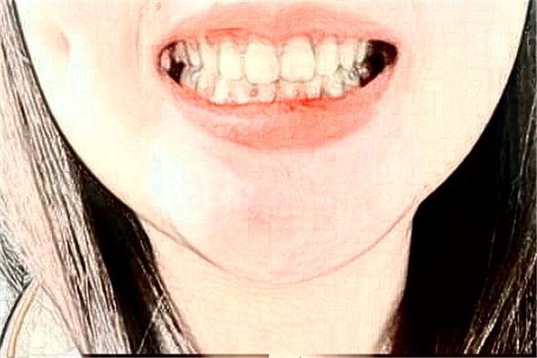 2024遼寧省人民醫(yī)院牙齒美白好么?醫(yī)生推薦+整形案例參考~