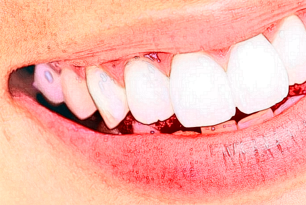 山西省人民醫(yī)院全口種植費(fèi)用多少?整形日記全過(guò)程