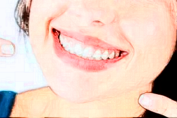 2024成都新橋口腔醫(yī)院補牙價格?補牙要多久時間