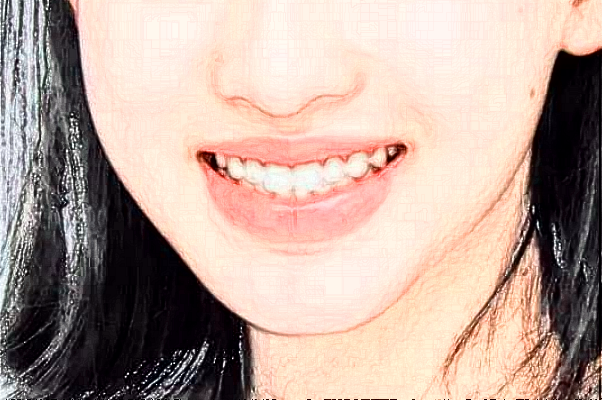 2024鄭州植得口腔醫(yī)院種牙多少錢?種牙好還是鑲牙好