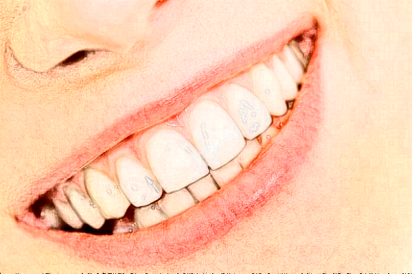 2024天津南開醫(yī)院牙齒美白怎么樣_整形日記分享