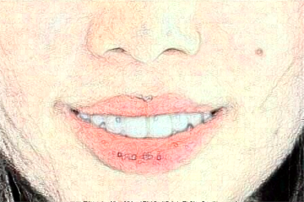 襄陽新德恩口腔門診部種植牙怎么樣_誰做得好