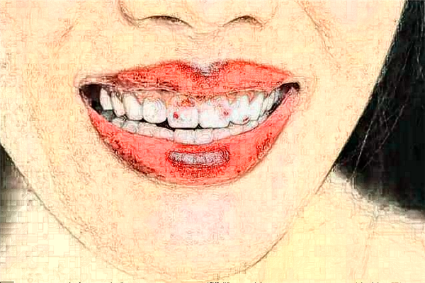 蘇州姑蘇美奧口腔地包天矯正費用多少_真實案例反饋