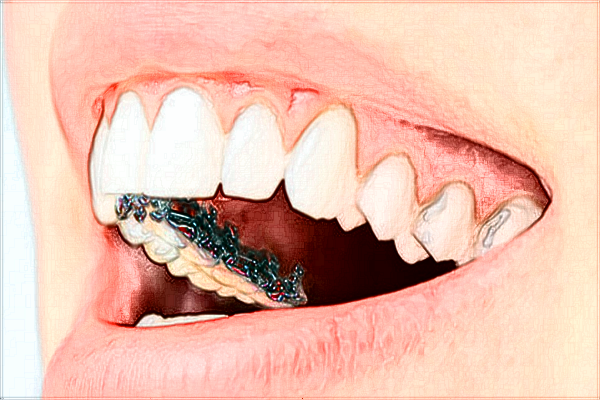 2024成都新橋口腔醫(yī)院種植牙收費(fèi)標(biāo)準(zhǔn)?種植牙能維持幾年