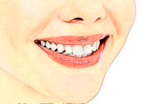 2024中山香山口腔醫(yī)院瓷貼面多少錢?瓷貼面牙齒有危害嗎