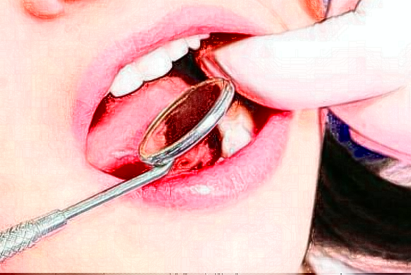 2024中山香山口腔醫(yī)院全瓷牙價(jià)格?全瓷牙會不會有后遺癥?