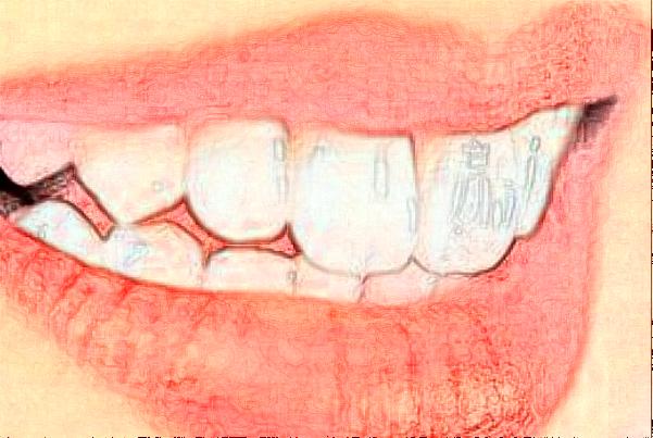 2024杭州植得口腔門(mén)診部地包天矯正做的好嗎
