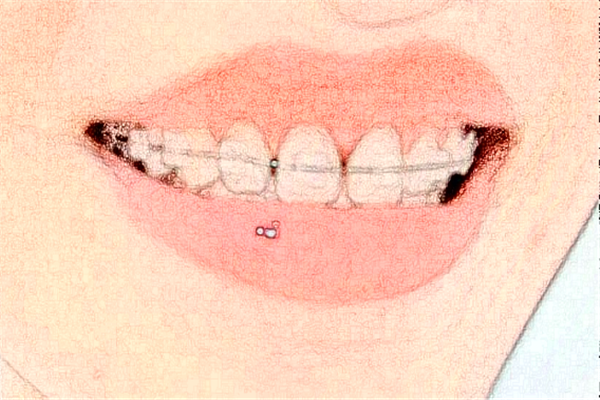 鄭州唯美口腔醫(yī)院正畸多少錢(qián)?做的怎么樣