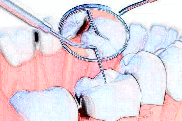 2024福州登特口腔醫(yī)院牙齒種植費用多少_醫(yī)生名單