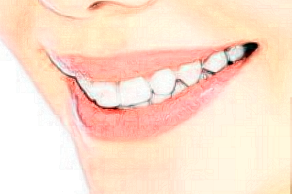 2024杭州雅萊口腔瓷貼面價格來咯!還有案例可以參考