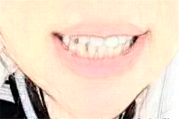 成都圣貝牙科醫(yī)院美容冠價(jià)格多少?整形日記全過程分享