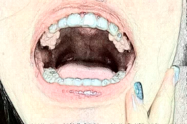 2024襄陽(yáng)新德恩口腔門診部牙齒美白費(fèi)用多少_真實(shí)案例反饋