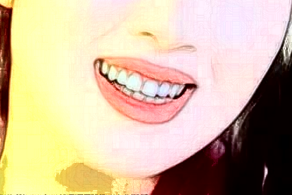 杭州雅萊口腔超聲波洗牙貴不貴?案例緊跟一覽!