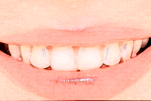 2024鄭州唯美口腔醫(yī)院瓷貼面整形案例_專家介紹