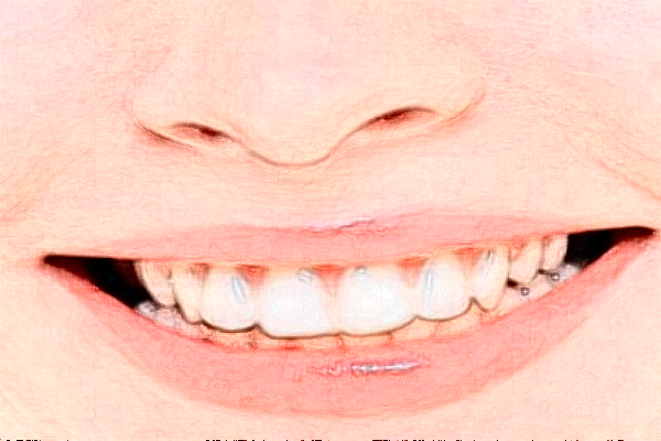 鄭州唯美口腔醫(yī)院美容冠價(jià)格多少?整形日記全過(guò)程分享