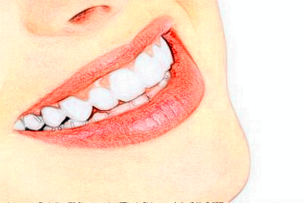 2024福州福能海峽口腔醫(yī)院瓷貼面貴不貴?案例緊跟一覽!