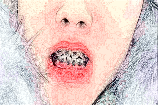 2024徐州諾恩口腔瓷貼面好嗎|專家醫(yī)生|案例分享