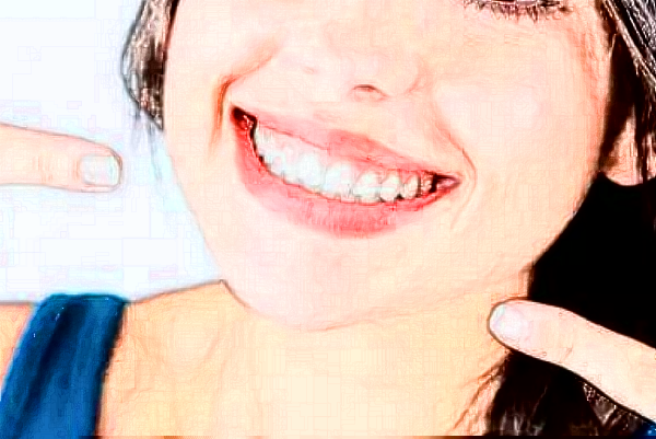 成都新橋口腔醫(yī)院根管貴不貴?2024根管費用