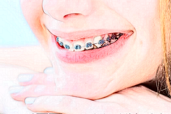 2024宣城大醫(yī)醫(yī)院金屬托槽矯正價(jià)格?金屬托槽矯正好嗎