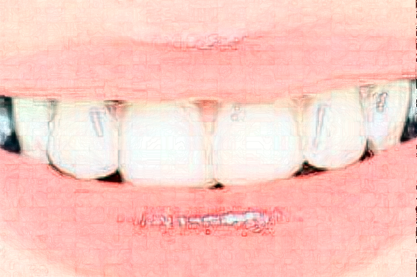 2024山東鉑爾口腔根管好不好?附術(shù)后案例參考!