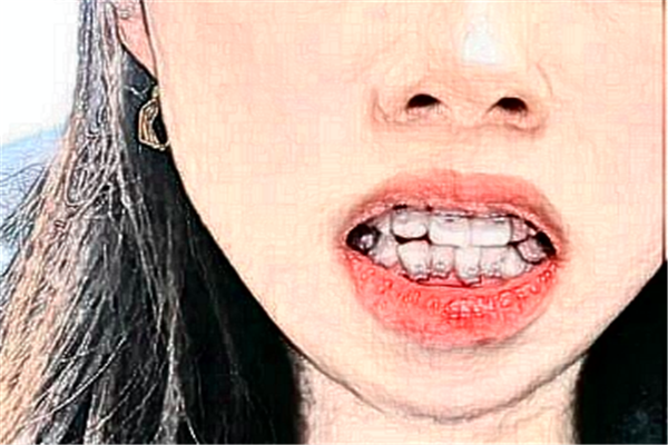 鄭州唯美口腔醫(yī)院種植牙價(jià)格多少?整形日記全過程分享