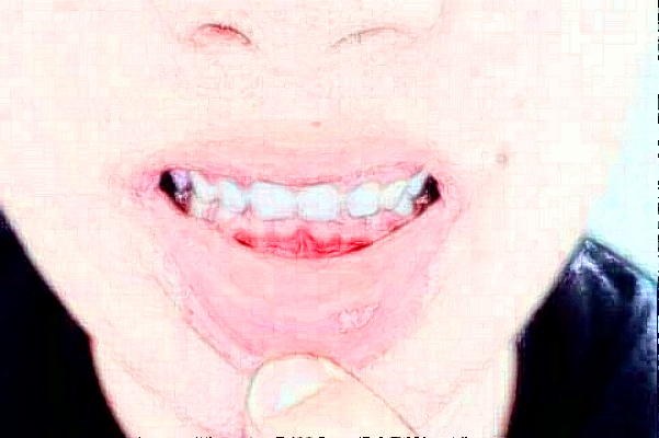 重慶團(tuán)圓口腔醫(yī)院正畸到底好不好?2024正畸牙齒的費用