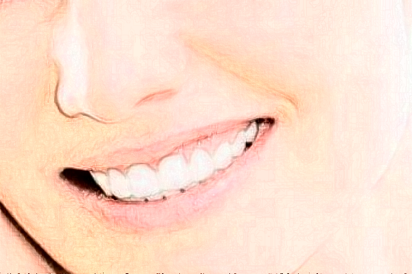 2024深圳樂莎莎口腔醫(yī)院拔牙費(fèi)用?拔牙后注意事項(xiàng)