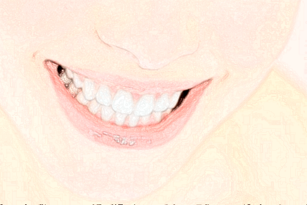 2024深圳樂莎莎口腔醫(yī)院補牙價格?補牙痛不痛?