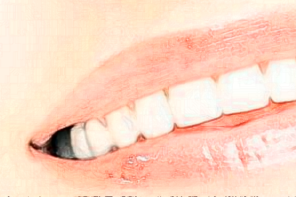 成都圣貝牙科醫(yī)院牙列擁擠矯正怎么樣|醫(yī)生介紹|價格收費(fèi)