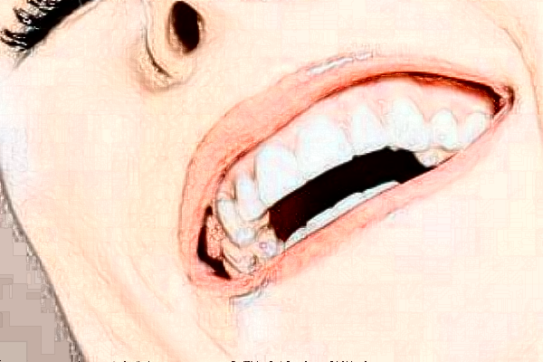 成都圣貝牙科醫(yī)院樹(shù)脂補(bǔ)牙好的醫(yī)生推薦_美容日記展示