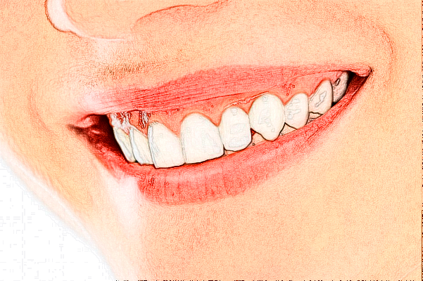 2024義烏傅氏口腔門診部隱適美價格?隱適美的缺點