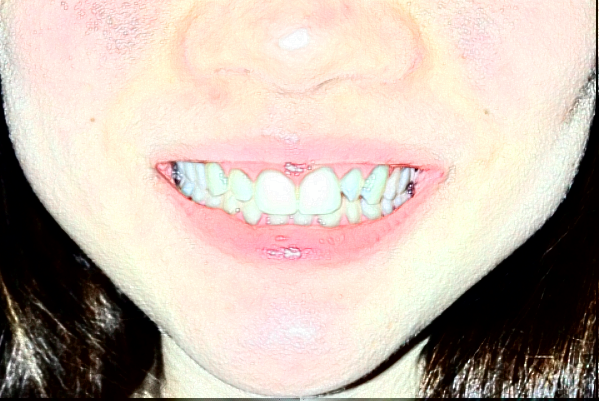 深圳樂莎莎口腔醫(yī)院超聲波洗牙原理?超聲波洗牙疼不疼