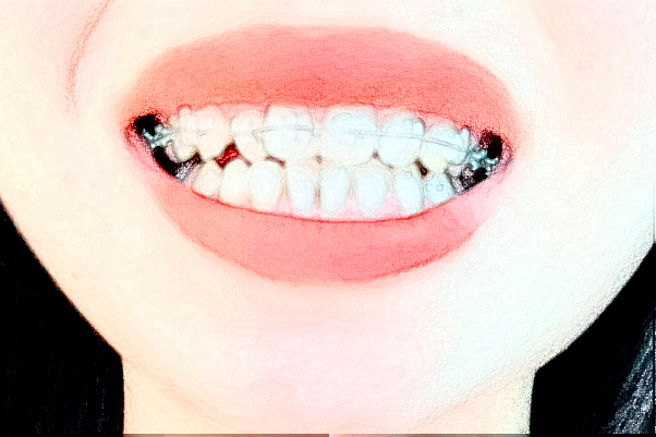 義烏傅氏口腔門診部全瓷牙能用多久?全瓷牙的危害