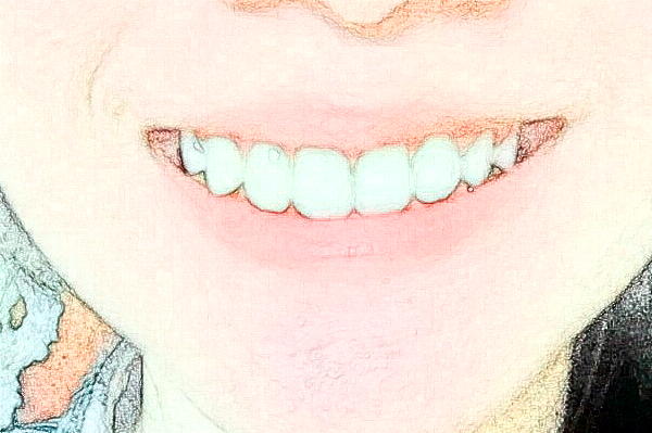 武漢德韓口腔醫(yī)院種植牙哪個(gè)好?種植牙過程會很痛嗎