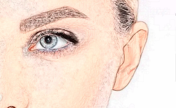 深圳因美醫(yī)療美容眼部去皺技術怎么樣?120天術后恢復案例