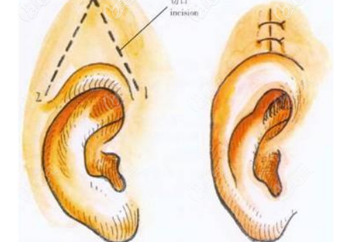 威海孫漫醫(yī)療美容診所杯狀耳矯正技術(shù)怎么樣?費用標(biāo)準(zhǔn)?術(shù)后半年案例