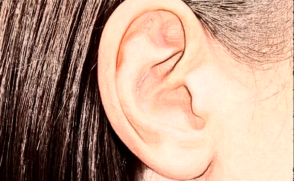 上海美萊醫(yī)療美容招風(fēng)耳矯正一般多少錢(qián)?技術(shù)亮點(diǎn)&術(shù)后一年案例揭秘