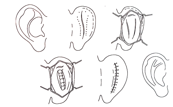 華中科技大學(xué)同濟(jì)醫(yī)學(xué)院醫(yī)院杯狀耳矯正術(shù)后三個月案例曝光|技術(shù)能力怎么樣?費(fèi)用多少