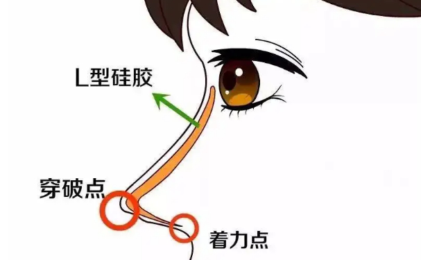 駐馬店美蘭德整形美容醫(yī)院整鼻子多少錢(qián)?技術(shù)優(yōu)勢(shì)&術(shù)后半年經(jīng)典案例