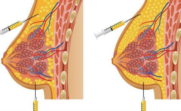 麗港麗格醫(yī)療美容門診部脂肪移植隆胸技術等級怎么樣?術后120天案例&價格