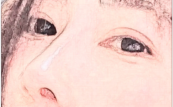 沈陽和平和顏仙島醫(yī)療美容診所微創(chuàng)雙眼皮術后半年案例曝光(效果怎么樣?技術水準)