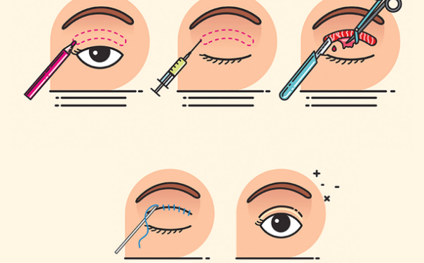 北京清木醫(yī)療美容診所做雙眼皮120天案例恢復過程&技術怎么樣?