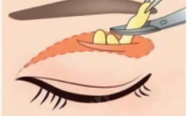 華中科技大學(xué)同濟醫(yī)學(xué)院醫(yī)院割腫泡眼雙眼皮90天親測案例全解&報價多少?