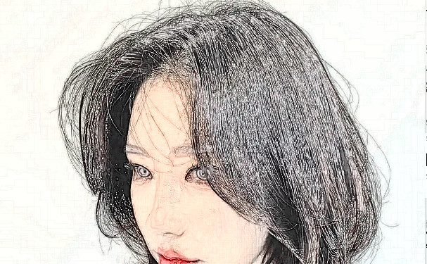 叢生植發(fā)植發(fā)一年案例點(diǎn)評(píng)(效果怎么樣?技術(shù)亮點(diǎn))